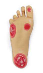 Picture of Optional Pressure Injury Foot Life/Form® Geri™LF04041