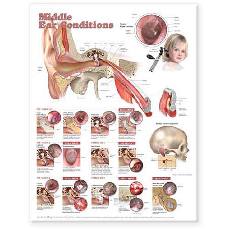 Picture of Anatomical Chart Middle Ear Conditions 20 X 26 Inch Heavy Paper Grommets Laminated9781605470962
