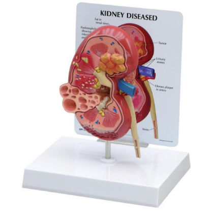 Picture of Diseased Kidney Model 3B Scientific®Z02805