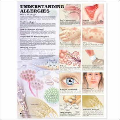 Picture of Anatomical Chart Understanding Allergies 2nd Edition 20 X 26 Inch Heavy Paper Laminated9781587799419