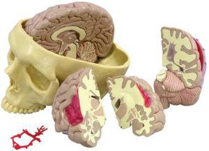 Picture of Brain in Skull Pathologies Model GPI Anatomicals810979