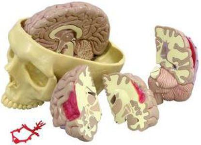 Picture of Brain in Skull Pathologies Model GPI Anatomicals810979