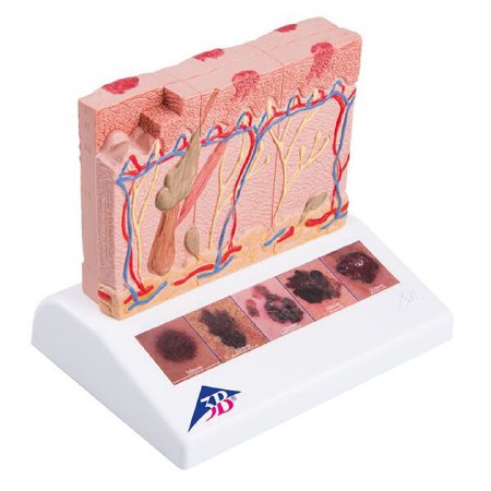 Picture of Skin Cancer Model 3B Scientific® .44 lbs.Z13802