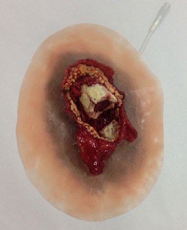 Picture of Moulage Xtreme Open Fracture Femur Plastic800-012