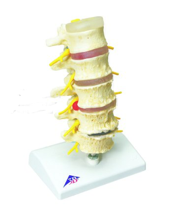 Picture of Vertebrae Degeneration, Stages of Prolapsed Disc Model 2 lbs.12-4542