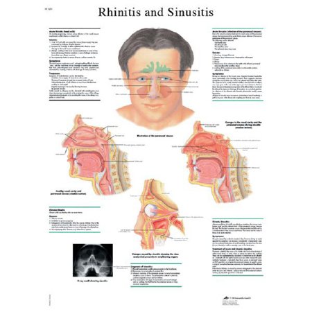Picture of Anatomical Chart 3B Scientific® Rhinitis and Sinusitis 19-7/10 X 26-2/5 Inch UV Resistant Paper LaminatedZ13398