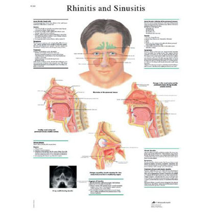 Picture of Anatomical Chart 3B Scientific® Rhinitis and Sinusitis 19-7/10 X 26-2/5 Inch UV Resistant Paper LaminatedZ13398