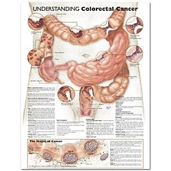 Picture of Anatomical Chart Understanding Colorectal Cancer 20 X 26 Inch Heavy Paper Grommets Laminated9780781773348