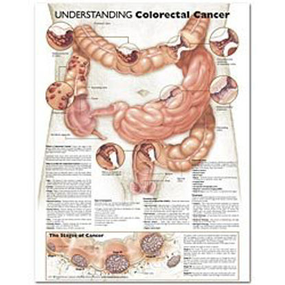 Picture of Anatomical Chart Understanding Colorectal Cancer 20 X 26 Inch Heavy Paper Grommets Laminated9780781773348