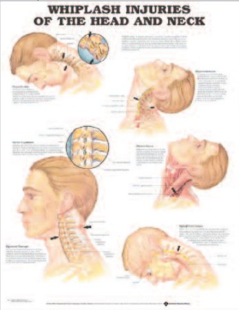 Picture of Anatomical Chart Whiplash 20 X 26 Inch Heavy Paper Grommets Laminated9781587793752