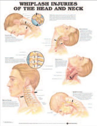 Picture of Anatomical Chart Whiplash 20 X 26 Inch Heavy Paper Grommets Laminated9781587793752