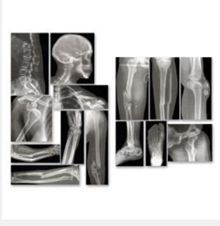 Picture of Broken Bones X-Rays Roylco®SB43367