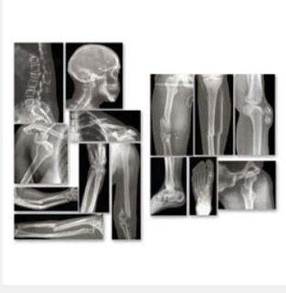 Picture of Broken Bones X-Rays Roylco®SB43367