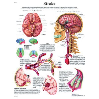 Picture of Anatomical Chart Stroke 20 X 27 Inch Laminated12-4629L