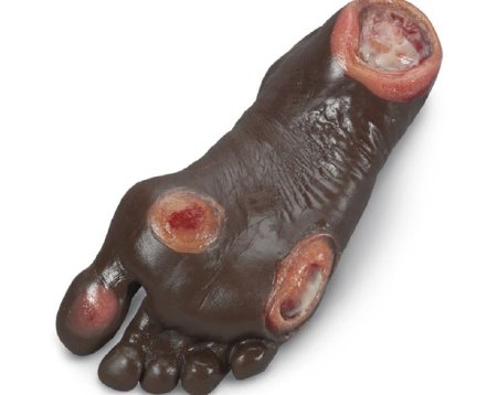 Picture of Elderly Pressure Ulcer Foot Life/Form®LF00944