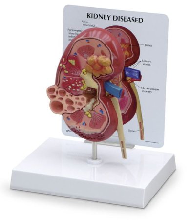 Picture of Kidney Model w/ Pathologies GPI Anatomicals®SB46337