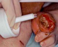 Picture of Hydrogel Dressing Intrasite 25 gm66027313