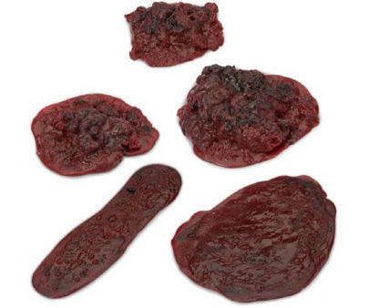 Picture of Clots and Hemorrhages - Set of 5 Life/Form®LF00714
