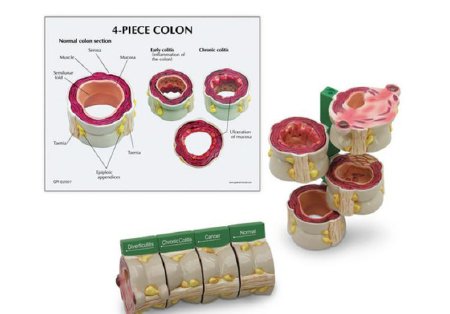 Picture of 4-Piece Colon Model with Pathologies GPI Anatomicals®SB46334