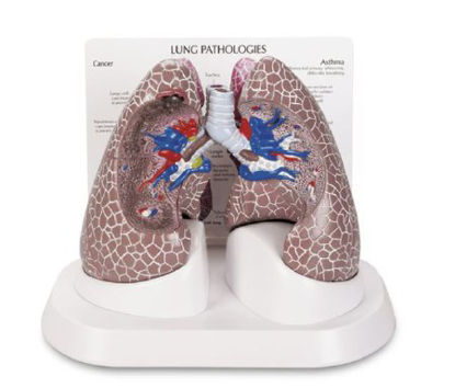 Picture of Lung Cancer Model Galloway PlasticsSB44894