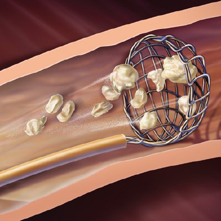 Picture of Stone Entrapment and Extraction Device NTrap® 2.8 Fr., 145 cm Length, 7 mm Umbrella Design BasketG32724