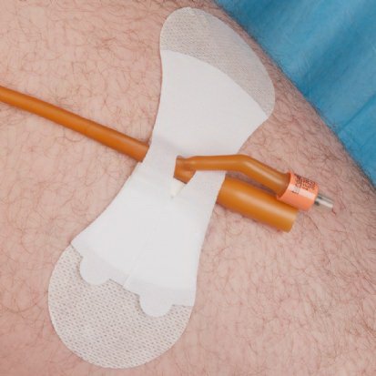 Picture of Catheter Stabilization Device GRIP-LOK® 6.25 Long, Sterile, Breathable, Adhesive3400LFC