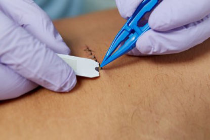 Picture of Suture Removal KitCHS85-4337