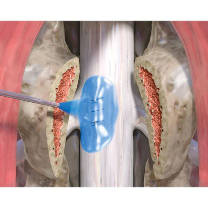 Picture of Spine Sealant System DuraSeal® Exact 3 mL High Viscosity Spray Tip Polyethylene Glycol (PEG) Ester Solution / Trilysine Amine Solution20-6320